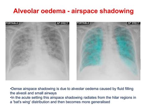 Chest Xrays Step By Step Approach Pptx