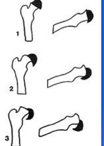 Fracture Classification Flashcards Quizlet