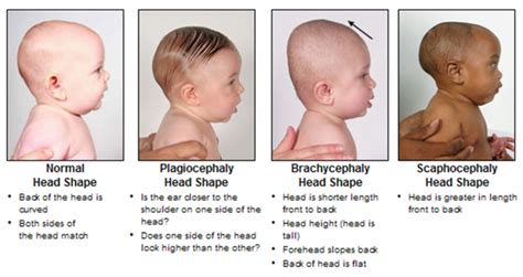 Why does my baby hold his head to one side | whydoesmybaby