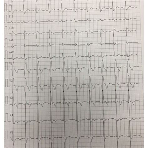 Electrocardiogram On Admission Shows Sinus Rhythm Complete Right