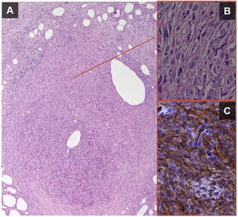 Histologic Appearance Of Dfsp Low Power View Hande Stain 2x Of Tumor