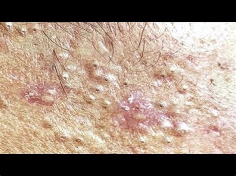 Loan Nguyen Acne Treatment (#162) - YouTube