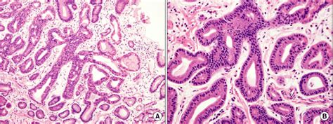 Histologic Diagnosis Is Oxyntic Gland Adenoma With High Grade Dysplasia