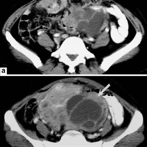 A B Peritoneal Carcinomatosis Axial Contrast Enhanced Ct Scan Of