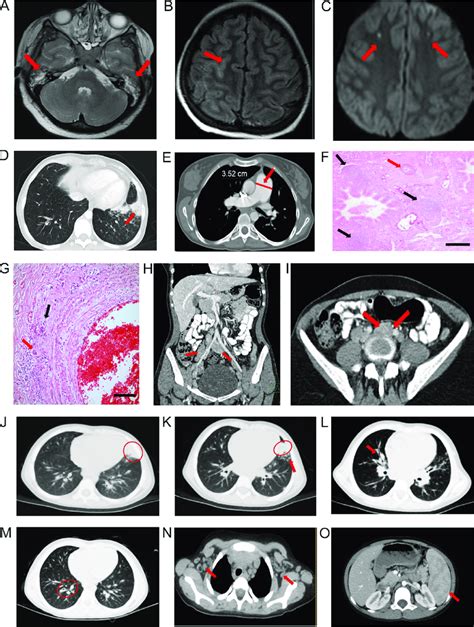 Radiological And Pathological Findings A I Pt A T Weighted