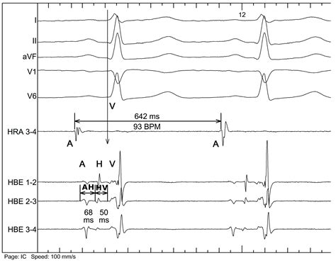 Jcm Free Full Text Dependence Of The Atrioventricular Conduction Time On The Conduction