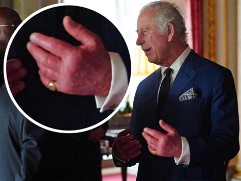 King Charles’ swollen fingers cause speculation about health | NT News