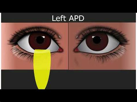 Relative Afferent Pupillary Defect - Medical Student Education - YouTube