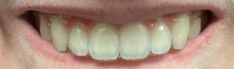 Teeth Becoming More Translucent How To Preventreverse Its Only The