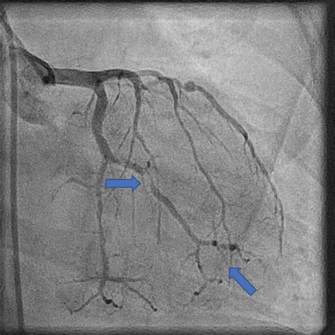 Stenosis Of The Obtuse Marginal Branch After Stent Placement Distal