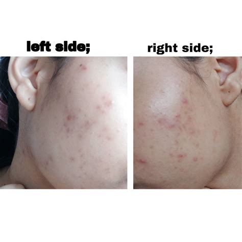 [acne] Closed Comedones Help R Skincareaddiction