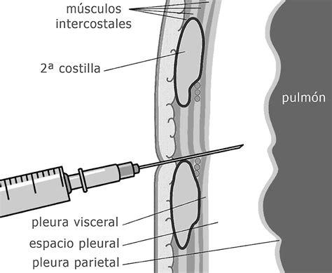 Neumotórax A Tensión De Descompresión Con Aguja