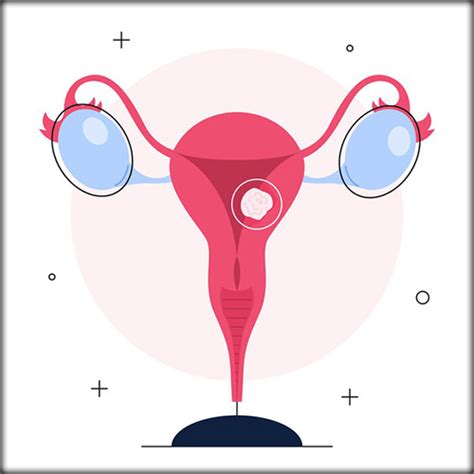 Uterine Cancer (Endometrial Cancer) – Symptoms, Stages & Treatment ...