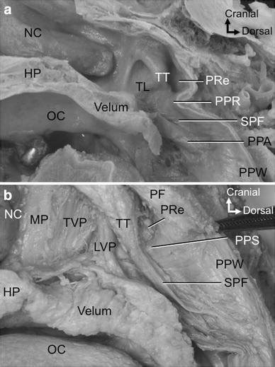 A Palatopharyngeal Ridge Ppr Is Shown On The Lowest Inner Wall Of The