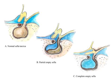 Get to know the cause of Empty Sella disease, a rare condition that ...