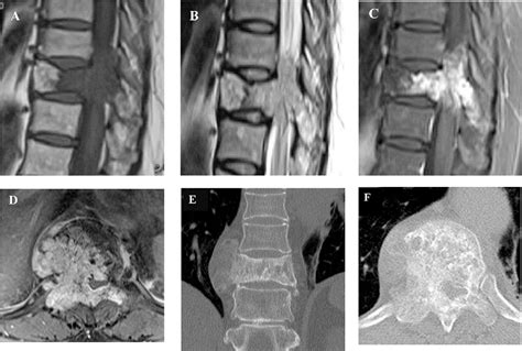 Thoracic Spine Hemangioma Causing Rapidly Progressive Myelopathy And