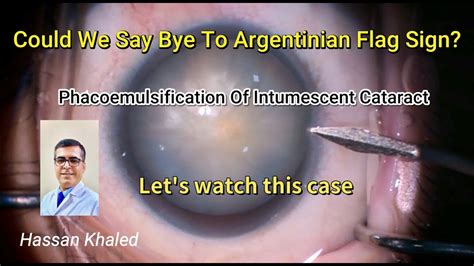 Could We Say Bye To Argentinian Flag Sign During Phacoemulsification Of