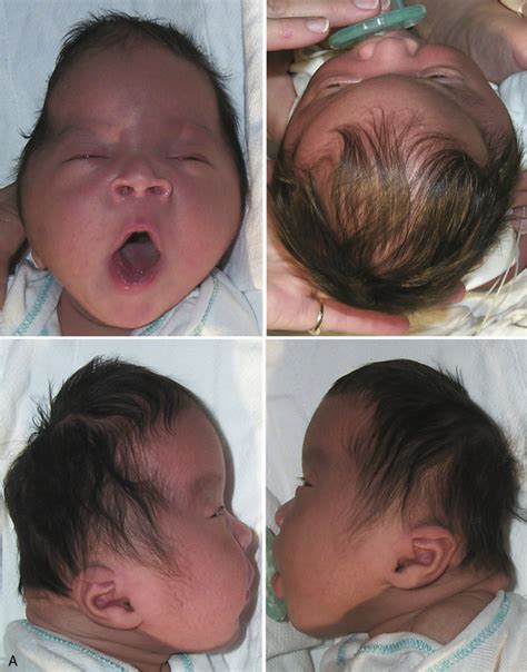 Fetal Skull Abnormalities