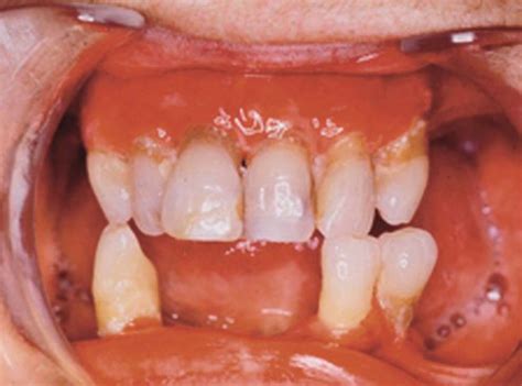 Mucous membrane pemphigoid | Plastic Surgery Key