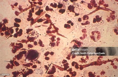 Neisseria Gonorrhoeae Bacteria Revealed In The Gram Stain Image Of A News Photo Getty Images