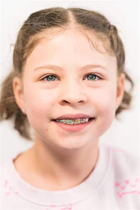 Brushing And Flossing Routines For Braces Wearers How To Maintain Oral