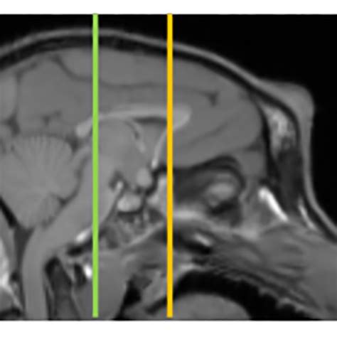 An example of how anterior cingulate cortex and posterior cingulate... | Download Scientific Diagram