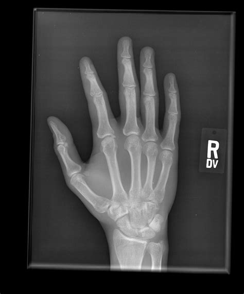 Hand X Ray Causes Symptoms Treatment Hand X Ray