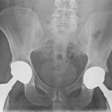 Anteroposterior Ap Pelvis Radiograph The Patient Initially Presented