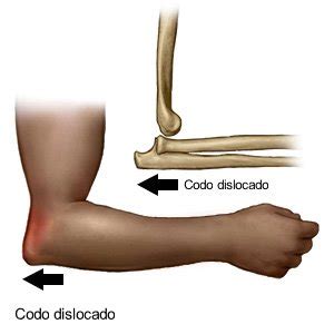 Yeso De Codo Dislocado