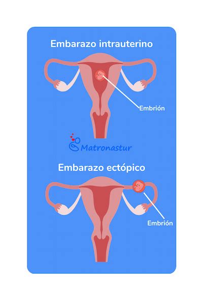 Descubre todo sobre el embarazo ectópico Matronastur