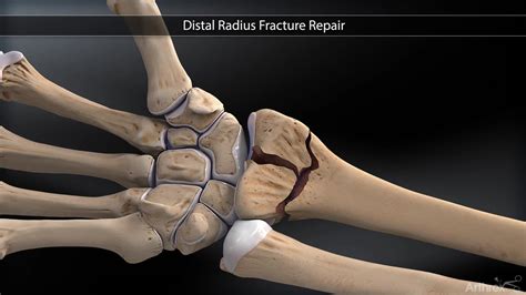 Arthrex Titanium Distal Radius Plates And Screws