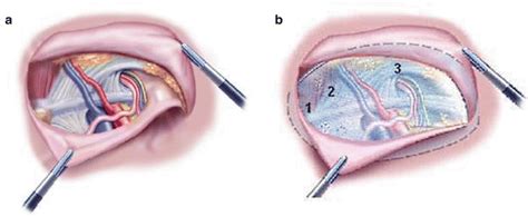 Laparoscopic Inguinal Hernia Surgery Anatomy