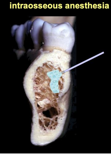 Local Anesthesia And Pain Control Flashcards Quizlet
