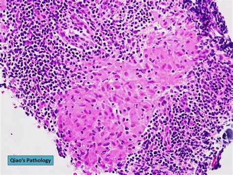 Qiao S Pathology Sarcoidosis Of Axillary Lymph Nodes A Photo On Flickriver