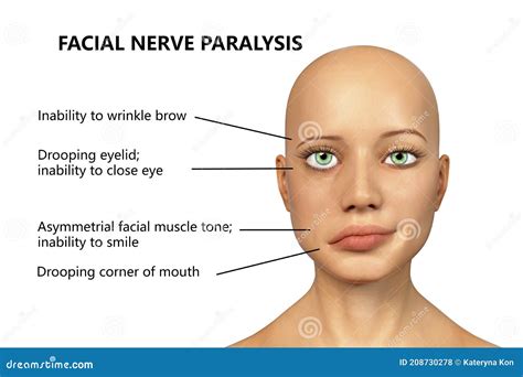 Facial Nerve Paralysis Stock Illustration Illustration Of Adult 208730278