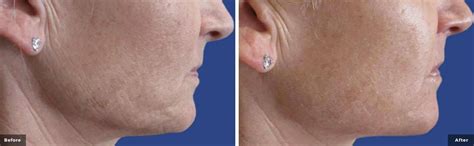 Rf Microneedling Westport And New Canaan Secret Rf