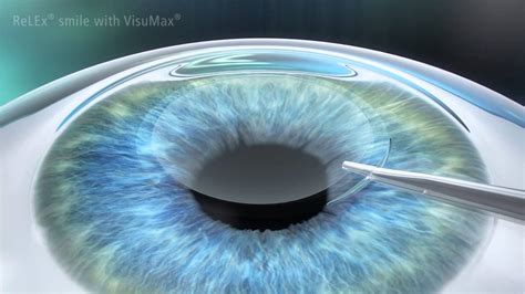 Carl Zeiss Meditec Visumax Relex Smile Youtube