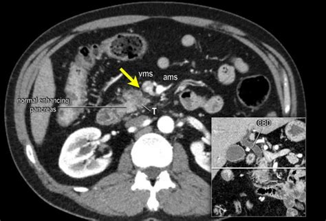 Normal Pancreas Cat Scan