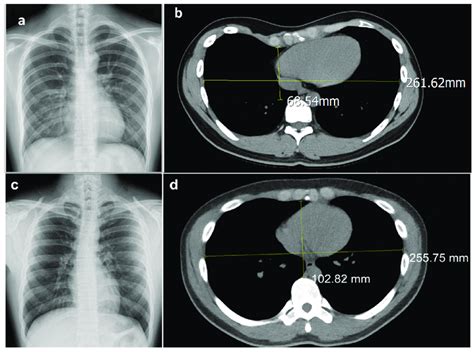 Pectus Excavatum Is Diagnosed By Haller Index 3 25 Calculation Of