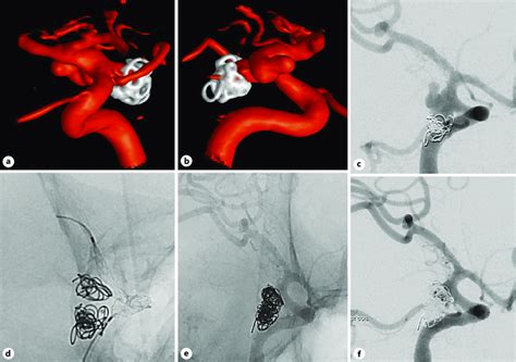 Previously coiled, ruptured wide-neck, dysplastic PCOM aneurysm. a, b ...