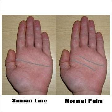 Turners Syndrome Hands Images & Pictures - Becuo