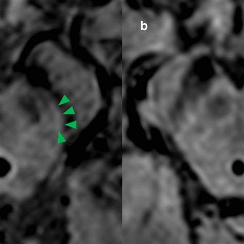 Evaluation Of Nigrosome 1 In High Resolution Mri Nigrosome 1 Download Scientific Diagram