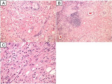 Hande Stain Ac Epithelial Like Cells And Fibrous Stroma The