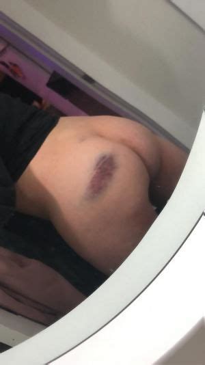 I Bruise So Easily Reddit NSFW