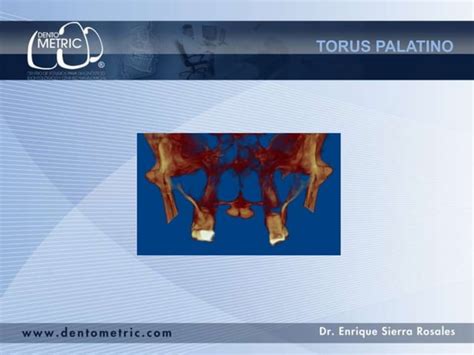 Torus Palatino Ppt