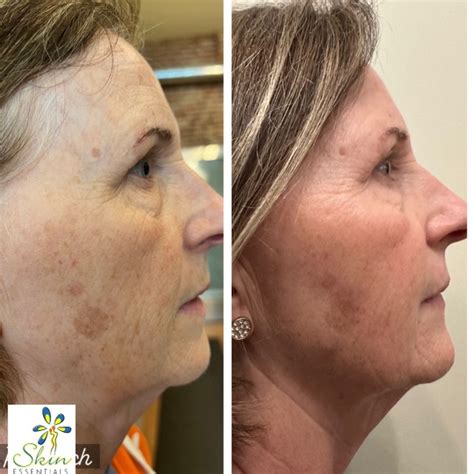 Opus Plasma Skin Resurfacing Skin Essentials