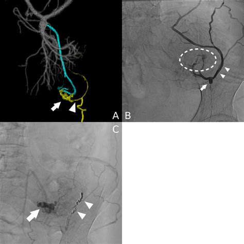 Case 1 A Preoperative 3d Contrast Enhanced Computed Tomography Download Scientific Diagram