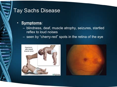 Tay Sachs Disease