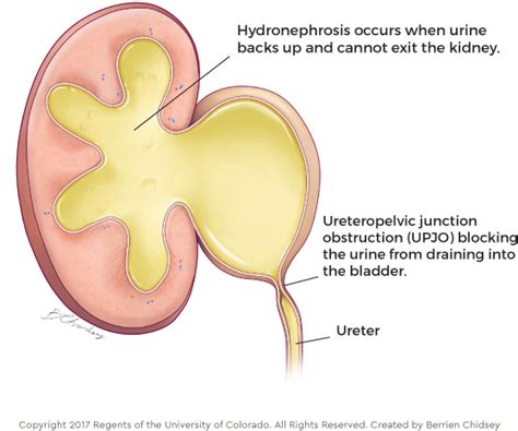 UPJ Obstruction In Children | Children's Hospital Colorado