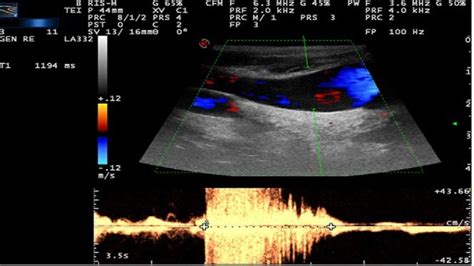 Ijv Valve Incontinence Lasting 0 88 S Elicited By A Valsalva Maneuver Download High Quality